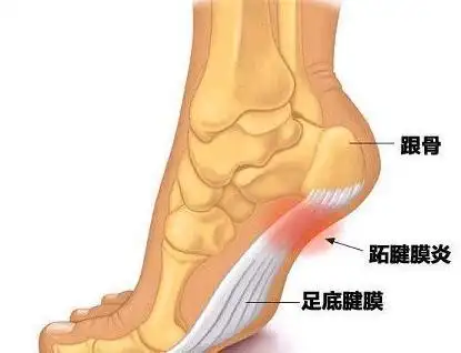 脚后跟疼痛怎么办4个中药方6个养护方法强效去痛根治病症