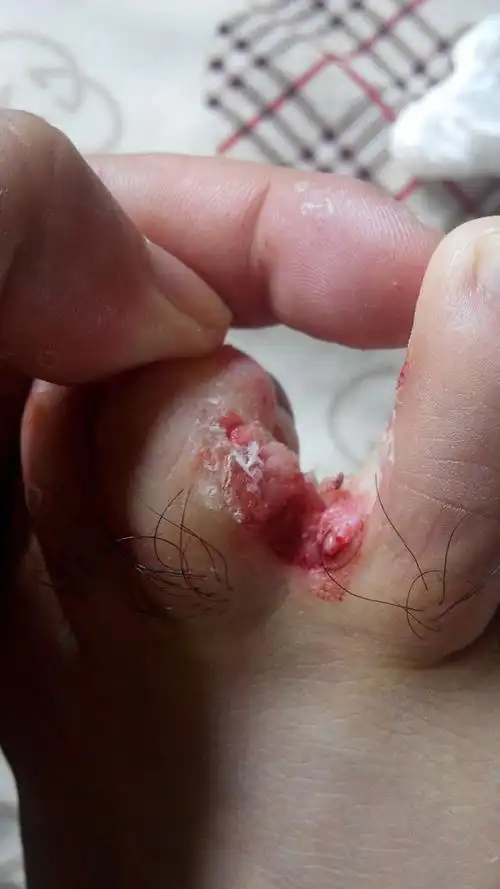 跖疣被挖出的时候图片