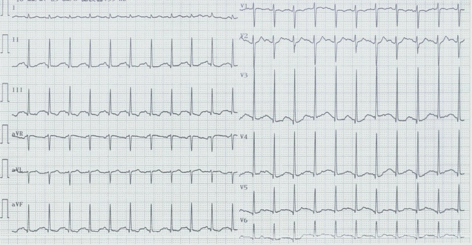 心电图试题与标准答案