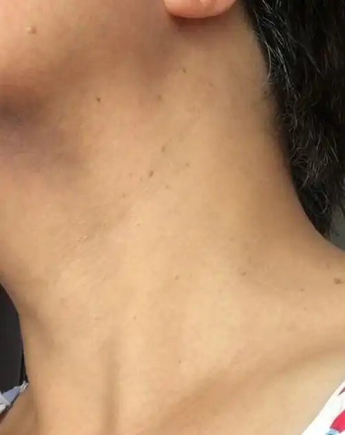 颈部出现许多这样的小颗粒,发的如芝麻,小的比米粒还小,不疼不痒,这是