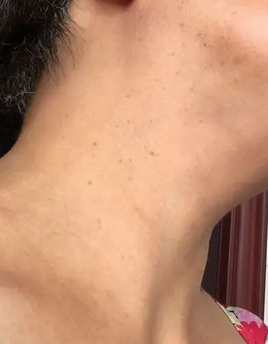 颈部出现许多这样的小颗粒,发的如芝麻,小的比米粒还小,不疼不痒,这是