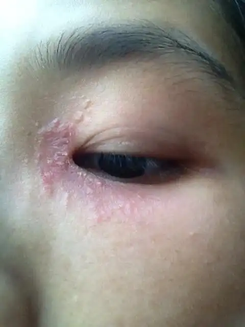 麦粒肿使用氧氟沙星眼膏和滴眼液后,眼肿消退,可是眼角周围皮肤变得红