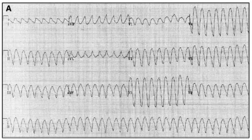出汗,气短"至当地医院就诊,入院查心电图示宽qrs波心动过速,心室率202