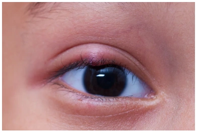 眼睛长痘痘麦粒肿还是霰粒肿