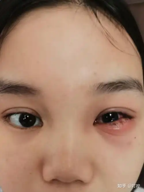 回来之后我就开始热敷 没想到加速了麦粒肿的成长 我整个眼睛就已经看