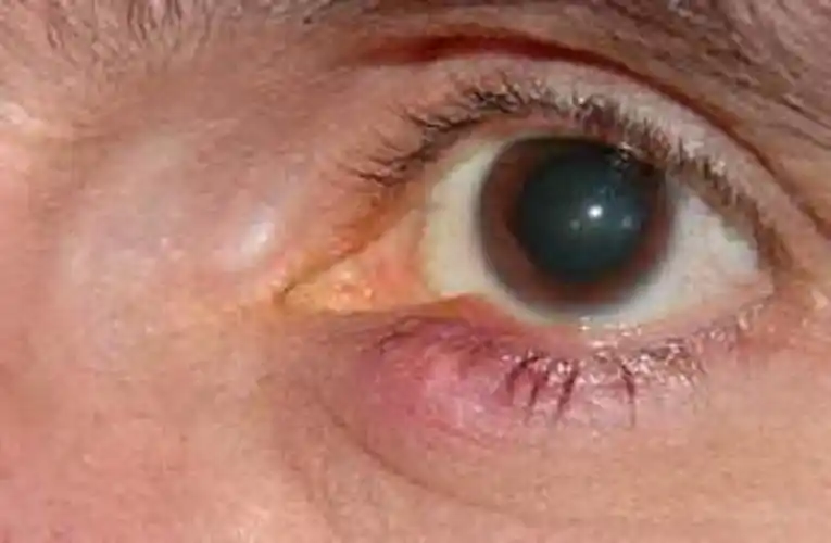 麦粒肿肉芽肿图片