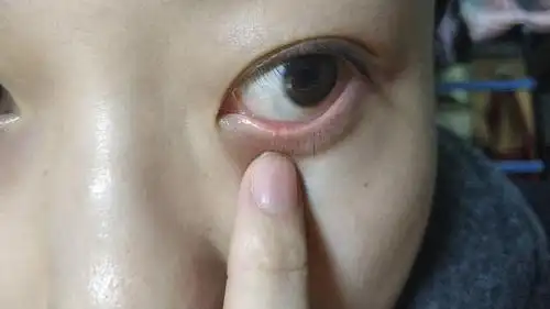 眼睑上长了个麦粒肿?闭口?油脂粒?